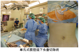 単孔式腹腔鏡下虫垂切除術