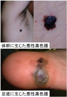 皮膚がん 中京病院 地域医療機能推進機構
