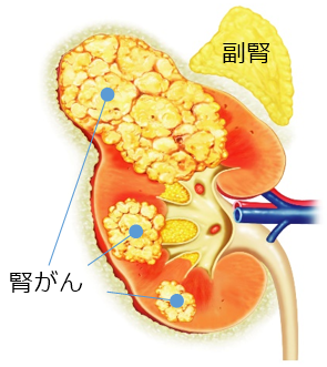 腎がんの詳細 中京病院 地域医療機能推進機構