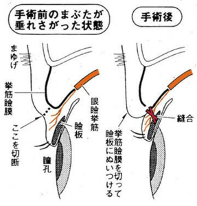 眼瞼下垂_図1
