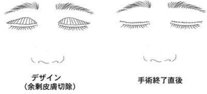眼瞼下垂_図2
